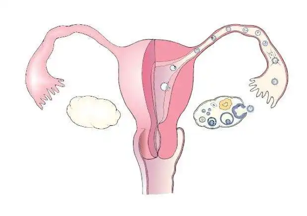 输卵管通水怎么做呢？试管婴儿需要疏通输卵管吗？