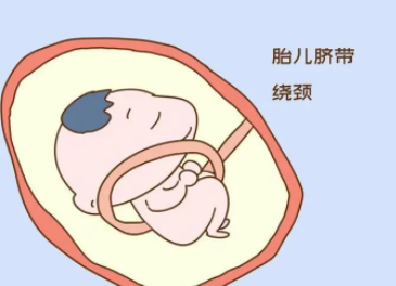 爱之晶：脐带绕颈是怎么发生的呢？会不会导致宝宝窒息呢？