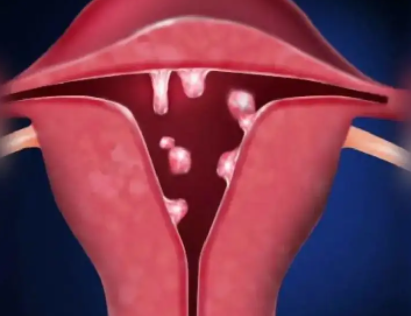 子宫内膜息肉对试管婴儿成功率有影响吗？